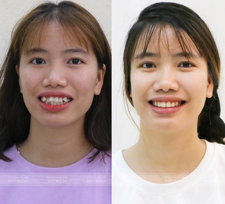 bang gia nieng rang mac cai kim loai hcm 3