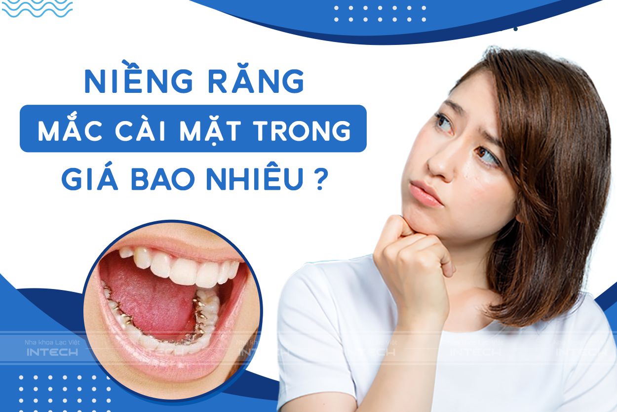 chi phi nieng rang mat trong gia cao 3