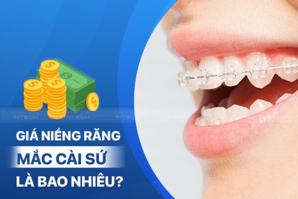 Bảng giá niềng răng mắc cài sứ tại TP.HCM mới nhất 1 gia nieng rang su phu thuoc nhieu yeu to 599x400 4