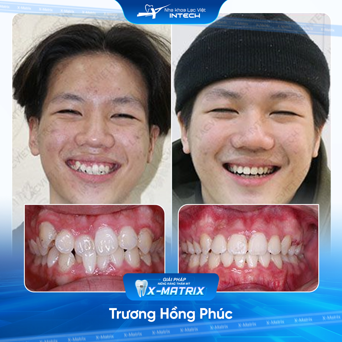 Bac si nieng rang Cao Linh nha khoa Lac Viet Intech