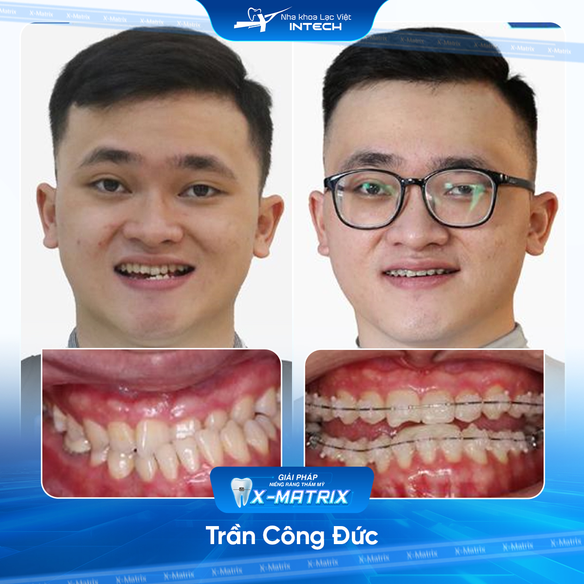 Bac si nieng rang Cao Linh nha khoa Lac Viet Intech