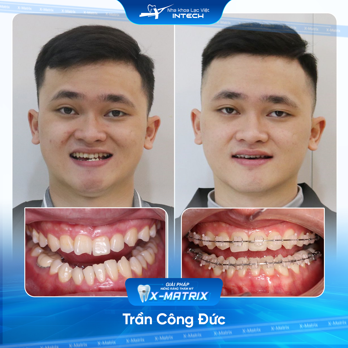 Bac si nieng rang Cao Linh nha khoa Lac Viet Intech