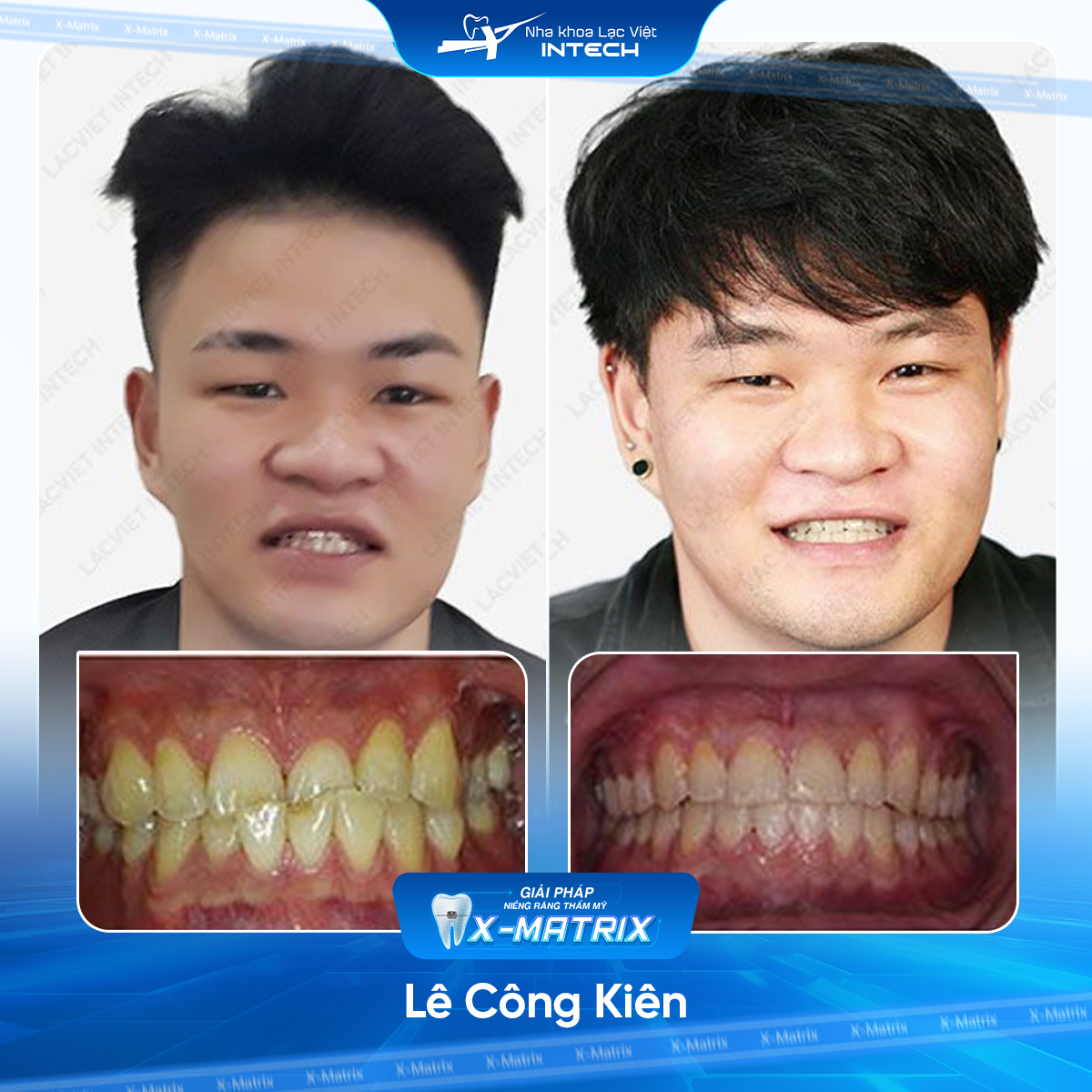 Bac si nieng rang Cao Linh nha khoa Lac Viet Intech