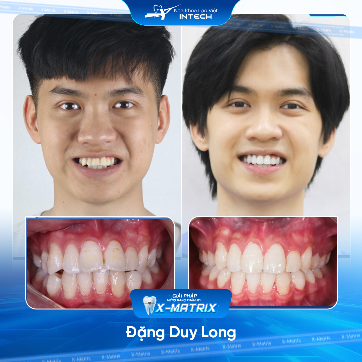 Bac si nieng rang Cao Linh nha khoa Lac Viet Intech