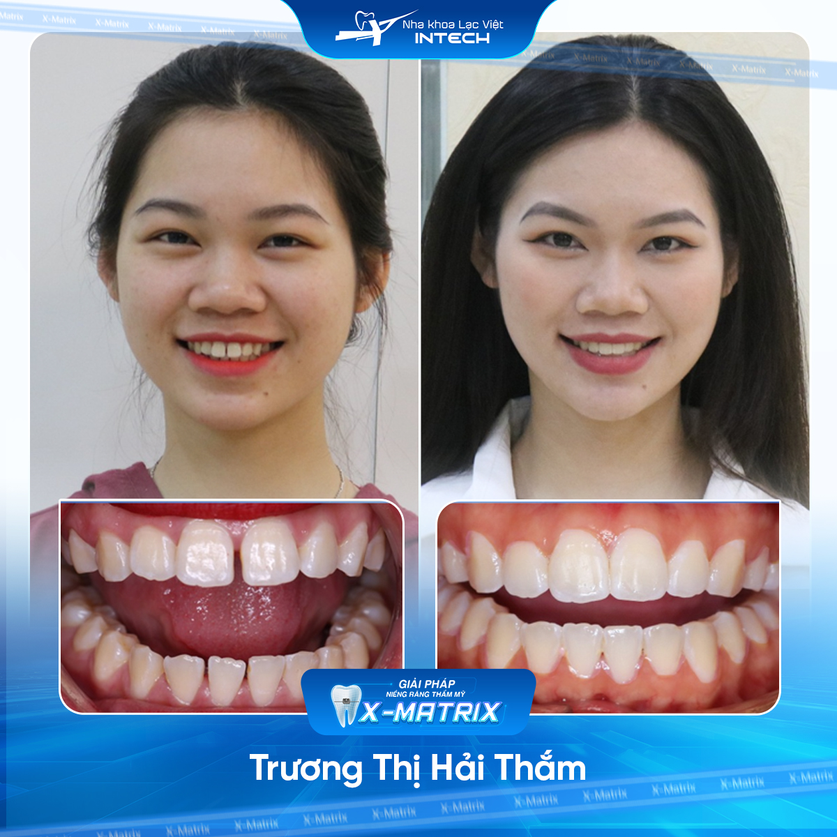 Bac si nieng rang Cao Linh nha khoa Lac Viet Intech