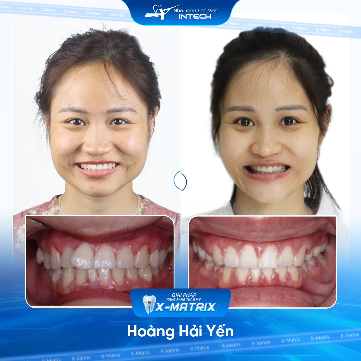 Bac si nieng rang Cao Linh nha khoa Lac Viet Intech