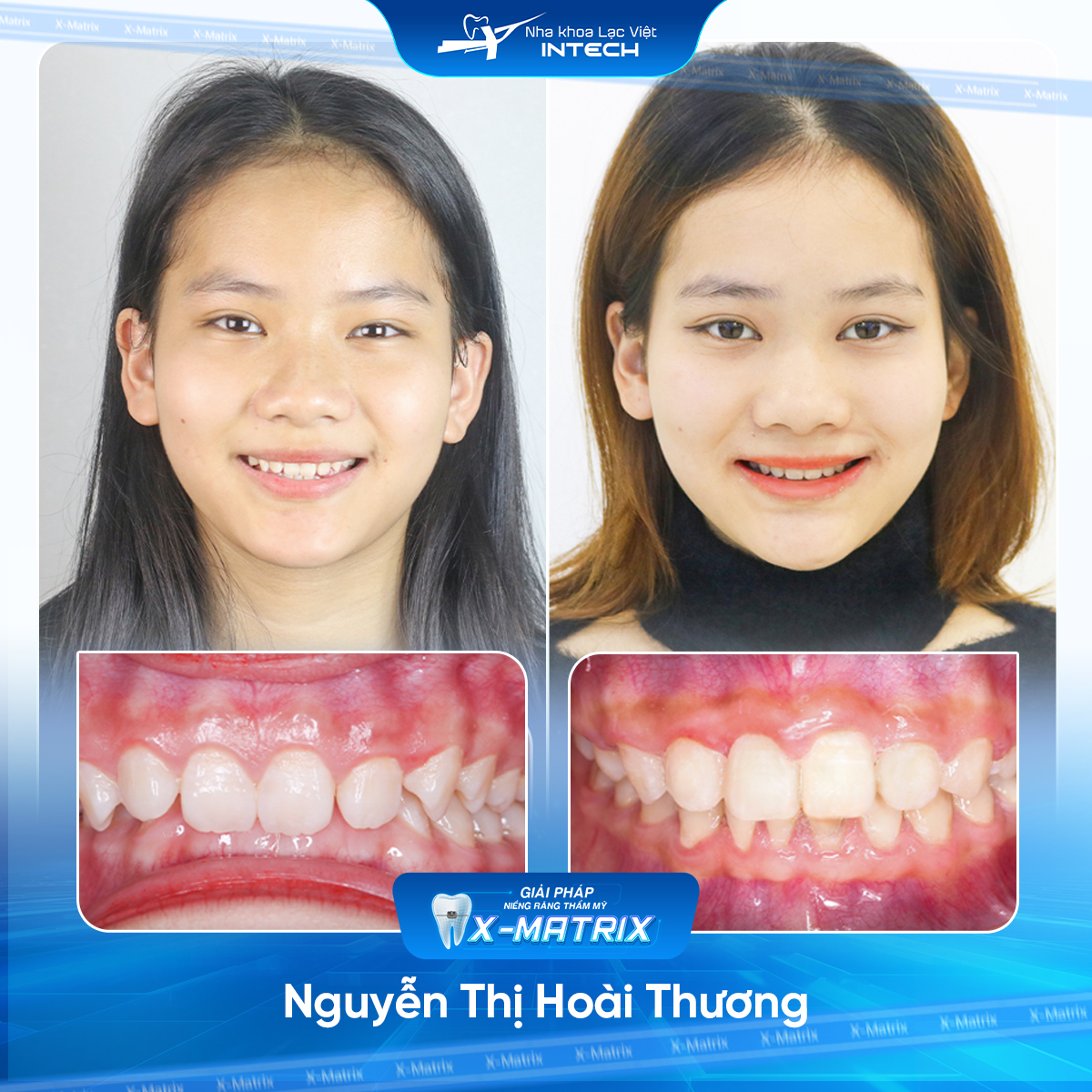 Bac si nieng rang Cao Linh nha khoa Lac Viet Intech