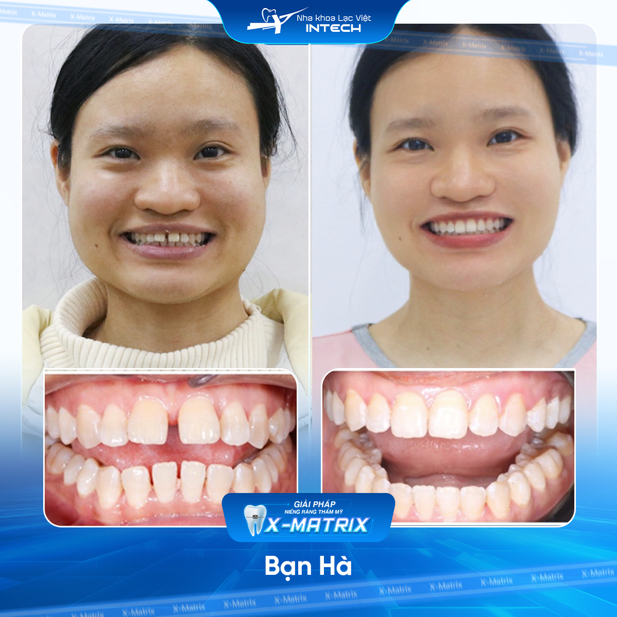 Bac si nieng rang Cao Linh nha khoa Lac Viet Intech