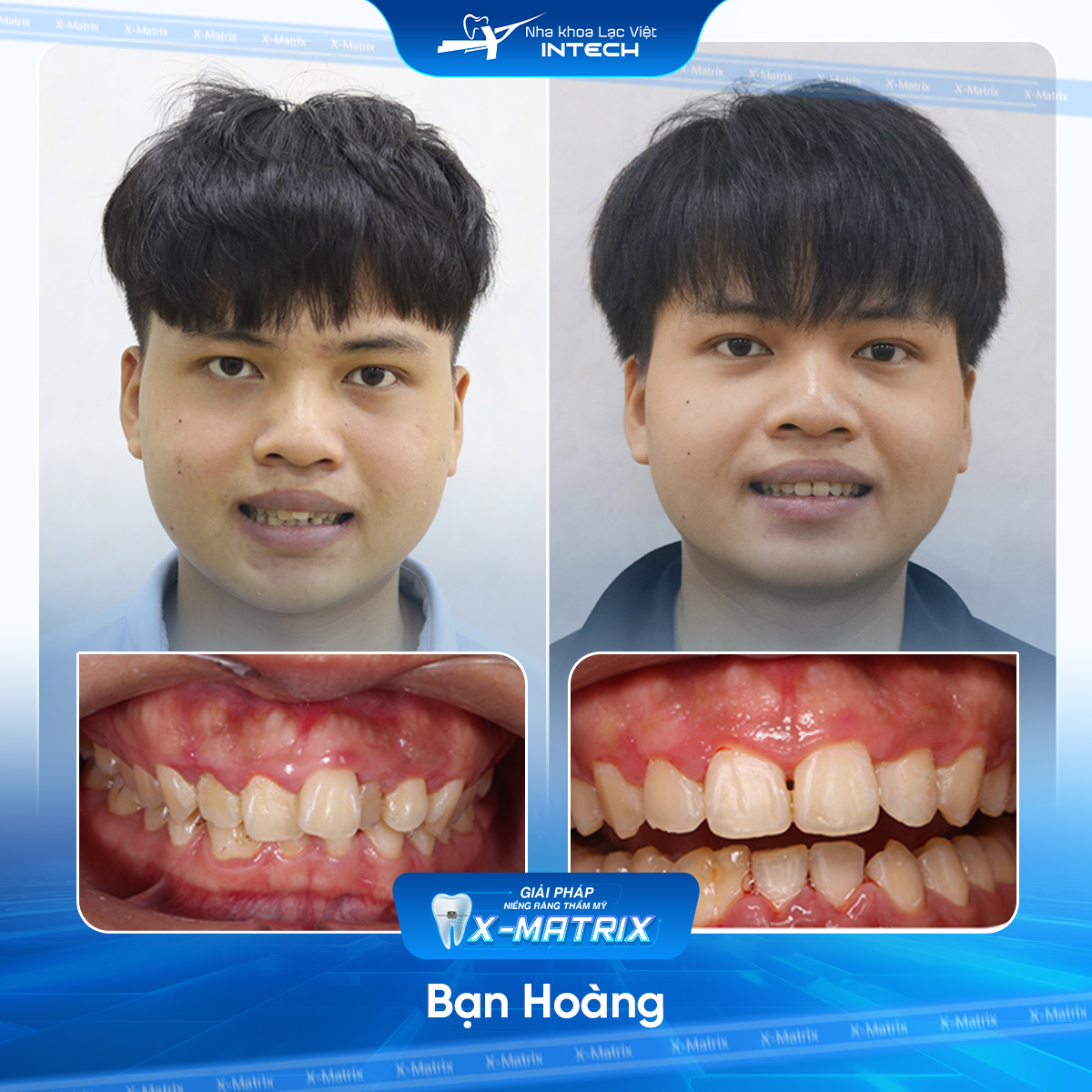 Bac si nieng rang Cao Linh nha khoa Lac Viet Intech