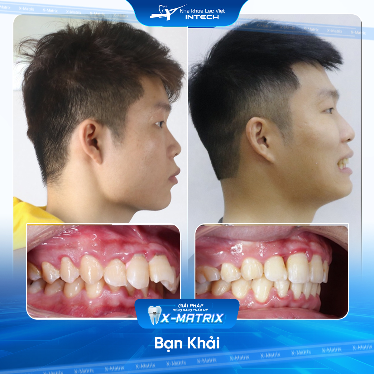Bac si nieng rang Cao Linh nha khoa Lac Viet Intech