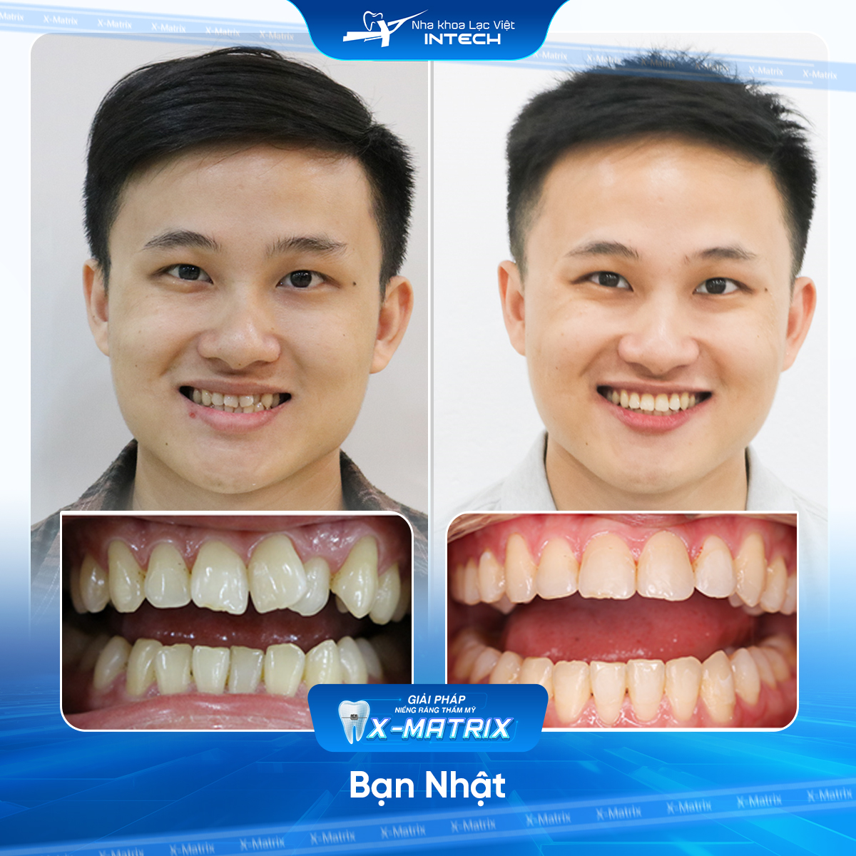 Bac si nieng rang Cao Linh nha khoa Lac Viet Intech