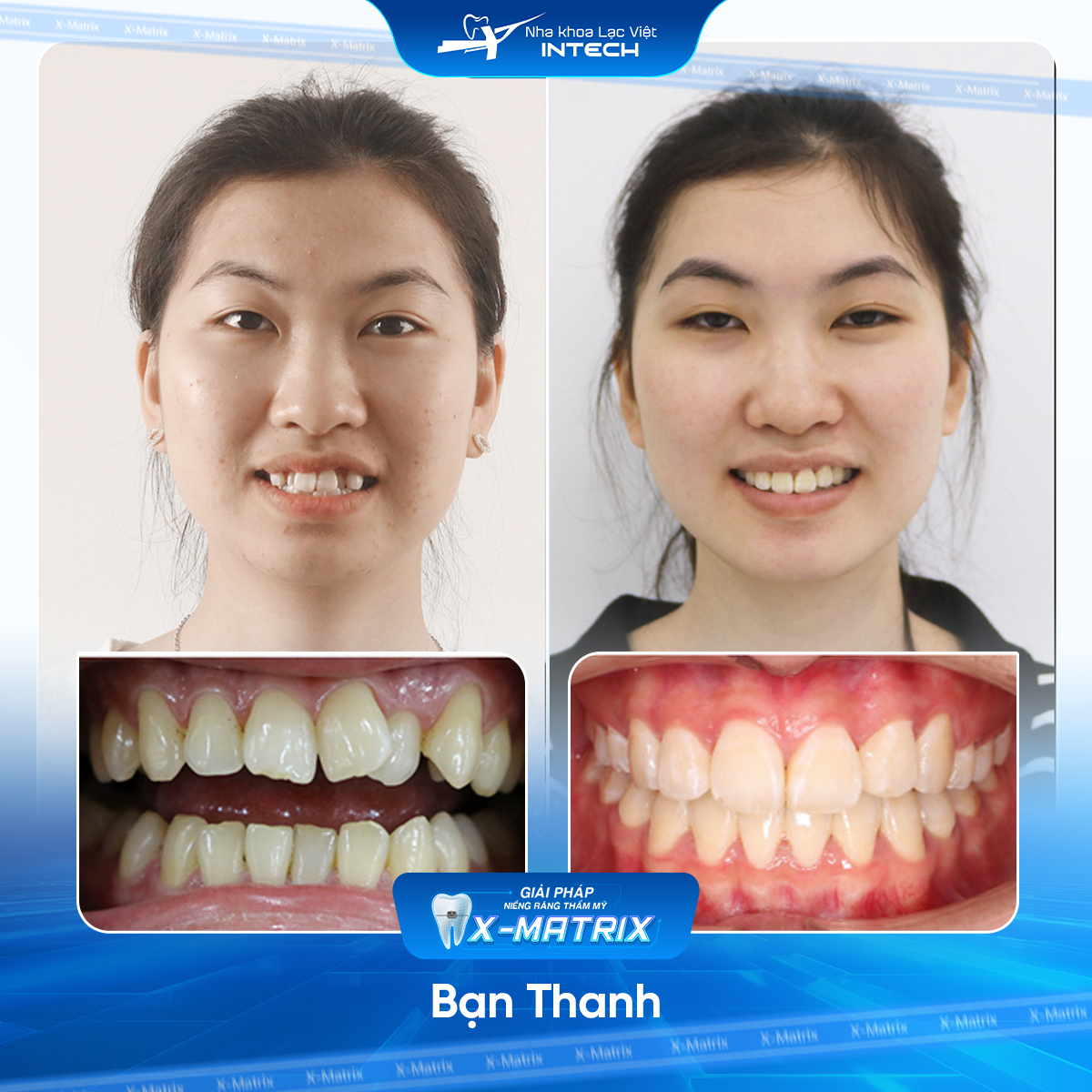 Bac si nieng rang Cao Linh nha khoa Lac Viet Intech