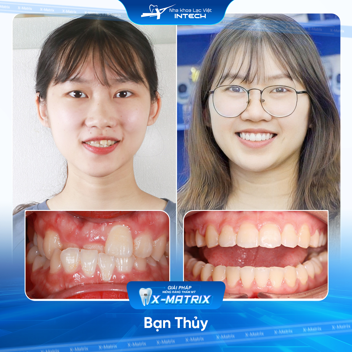 Bac si nieng rang Cao Linh nha khoa Lac Viet Intech