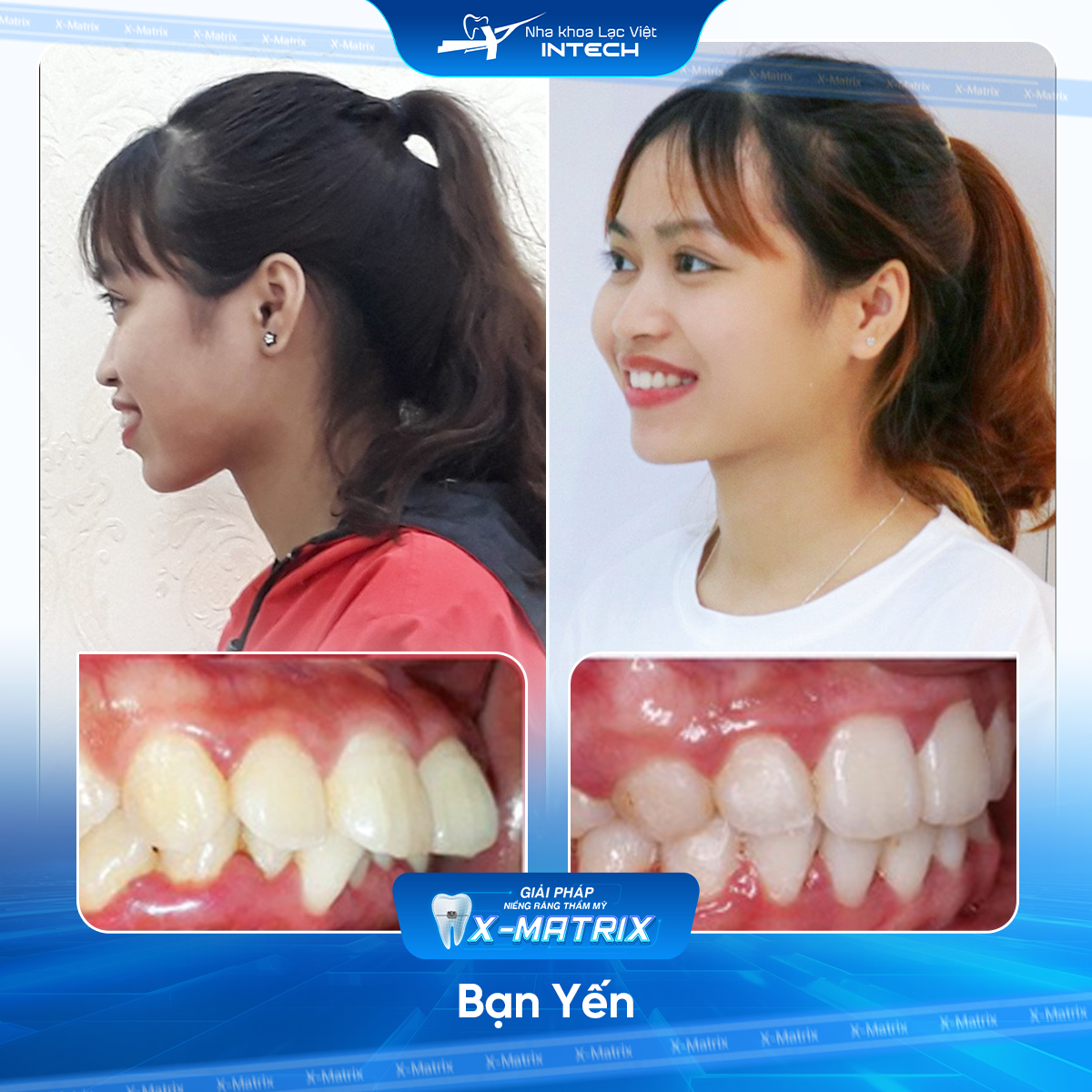 Bac si nieng rang Cao Linh nha khoa Lac Viet Intech