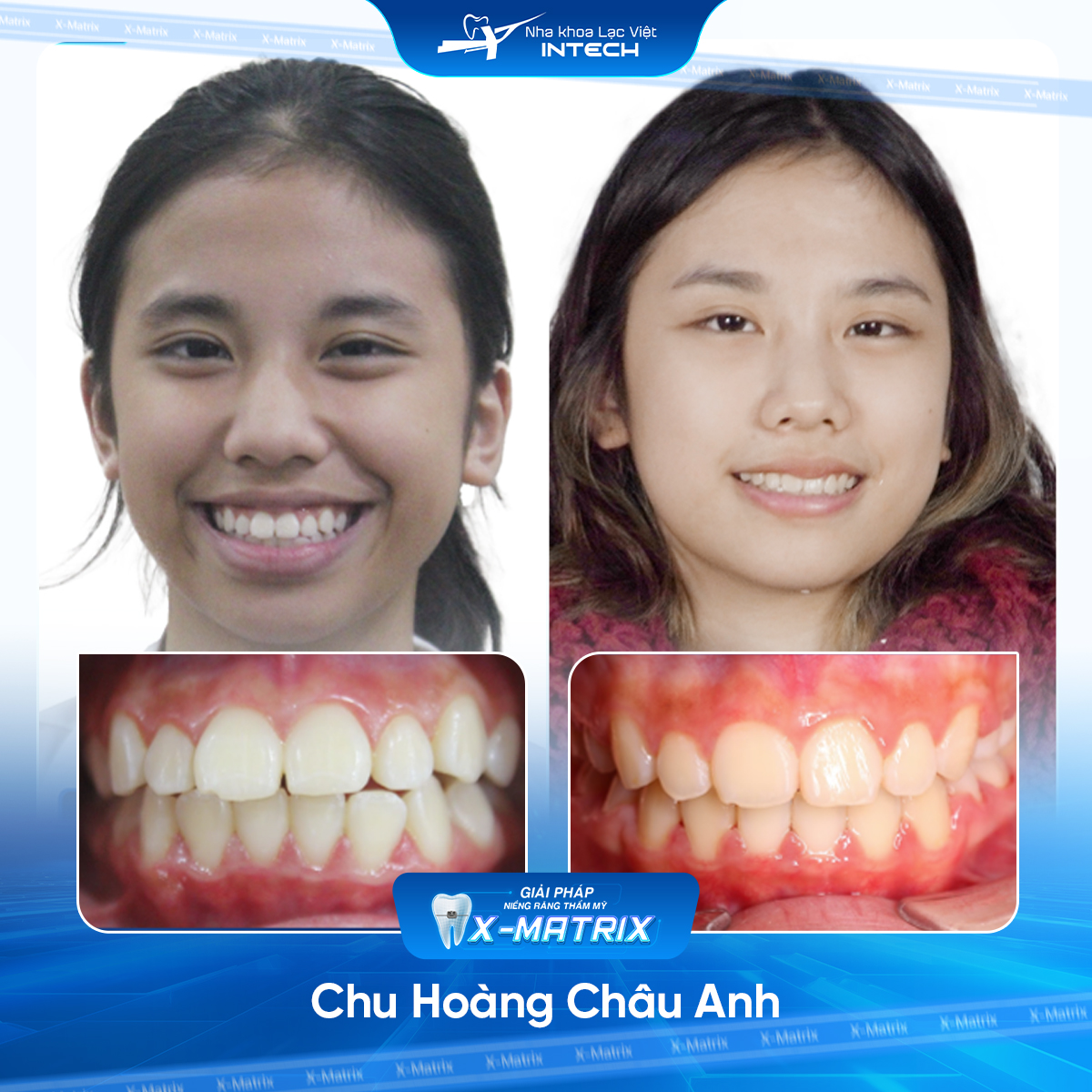 Bac si nieng rang Cao Linh nha khoa Lac Viet Intech