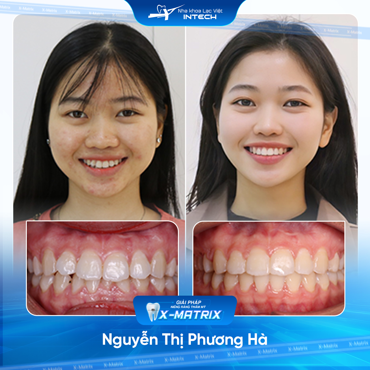 Bác sĩ niềng răng Lan Anh | Thông Tin - Đặt Lịch Bác Sĩ 9 Bac si nieng rang Lan Anh nha khoa Lac Viet Intech