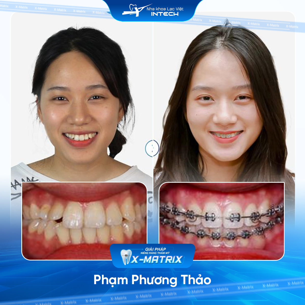 Bác sĩ niềng răng Lan Anh | Thông Tin - Đặt Lịch Bác Sĩ 10 Bac si nieng rang Lan Anh nha khoa Lac Viet Intech
