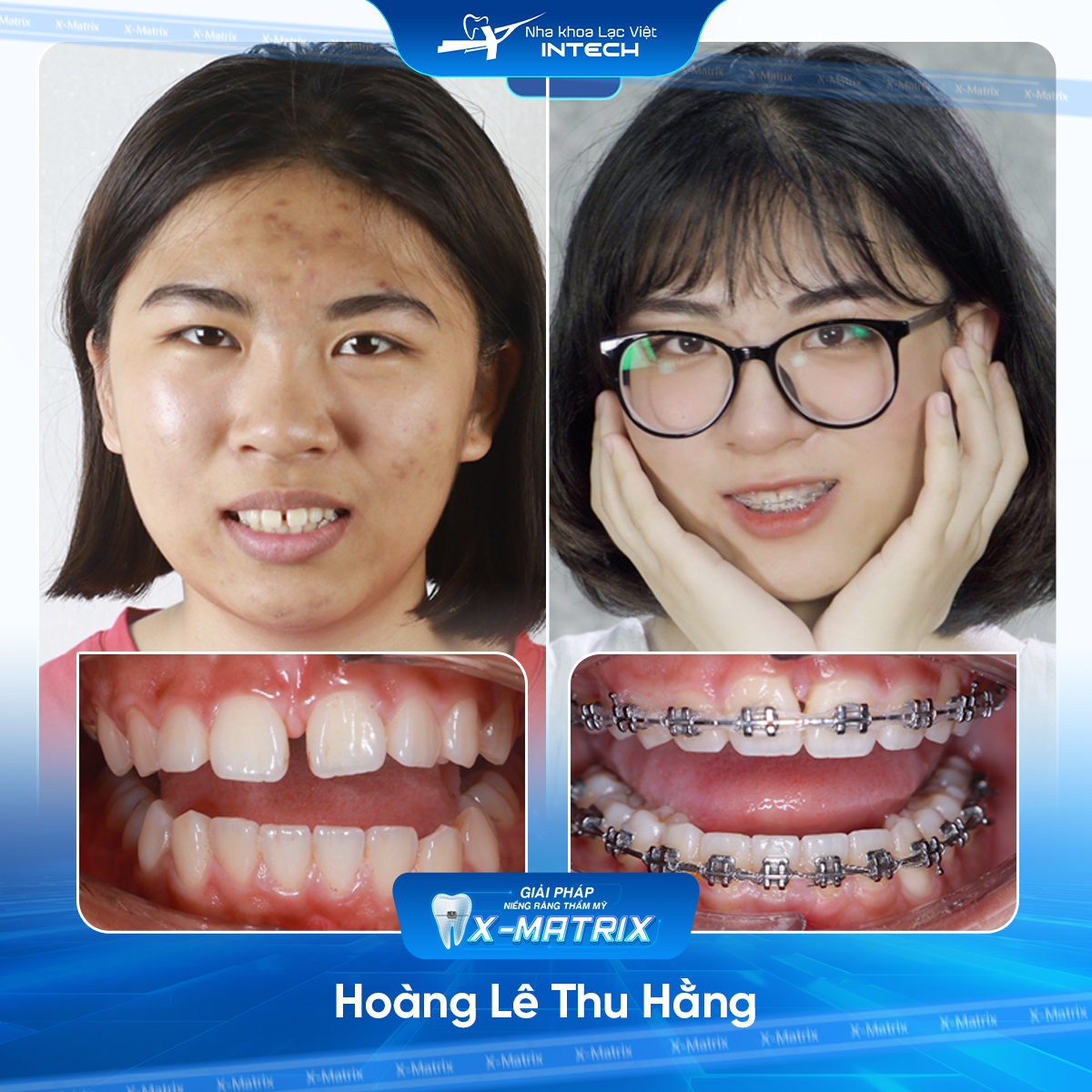 Bác sĩ niềng răng Lan Anh | Thông Tin - Đặt Lịch Bác Sĩ 11 Bac si nieng rang Lan Anh nha khoa Lac Viet Intech