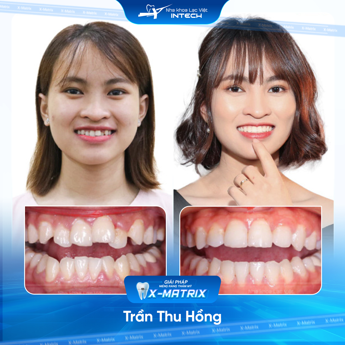 Bác sĩ niềng răng Lan Anh | Thông Tin - Đặt Lịch Bác Sĩ 12 Bac si nieng rang Lan Anh nha khoa Lac Viet Intech
