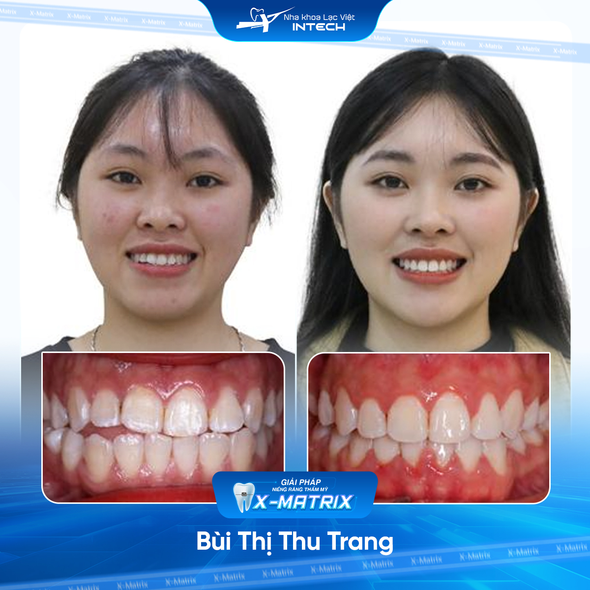 Bác sĩ niềng răng Lan Anh | Thông Tin - Đặt Lịch Bác Sĩ 13 Bac si nieng rang Lan Anh nha khoa Lac Viet Intech