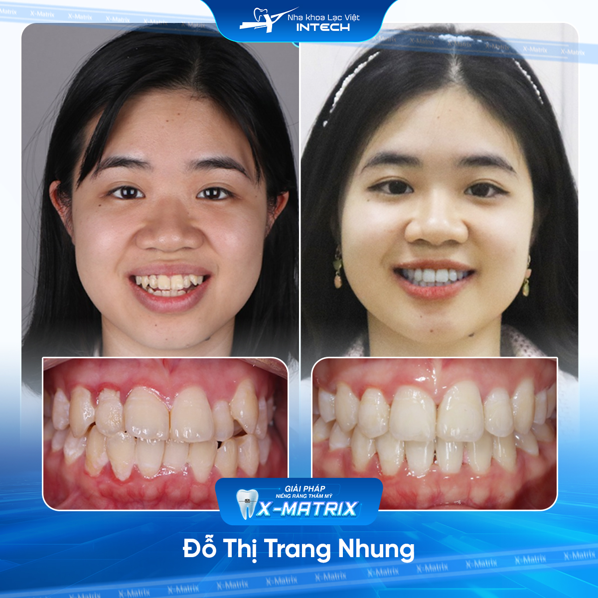 Bác sĩ niềng răng Lan Anh | Thông Tin - Đặt Lịch Bác Sĩ 14 Bac si nieng rang Lan Anh nha khoa Lac Viet Intech