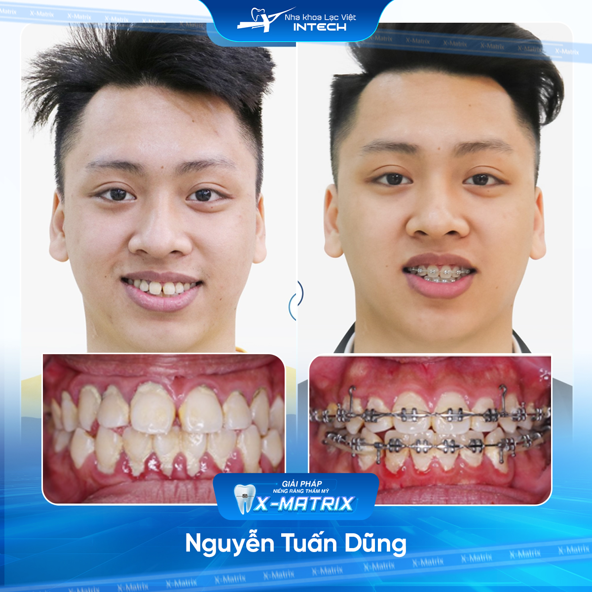 Bác sĩ niềng răng Lan Anh | Thông Tin - Đặt Lịch Bác Sĩ 15 Bac si nieng rang Lan Anh nha khoa Lac Viet Intech