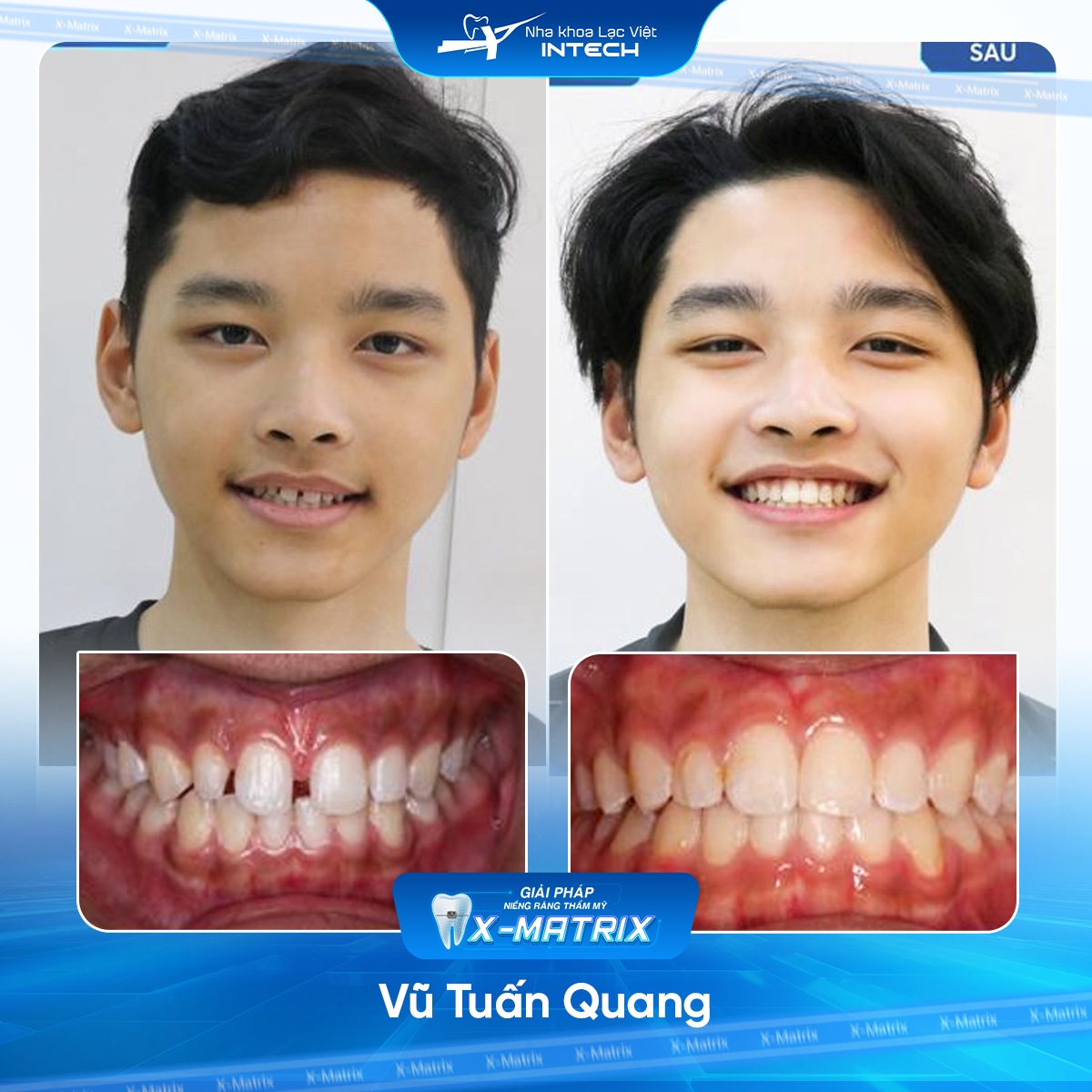 Bác sĩ niềng răng Lan Anh | Thông Tin - Đặt Lịch Bác Sĩ 16 Bac si nieng rang Lan Anh nha khoa Lac Viet Intech