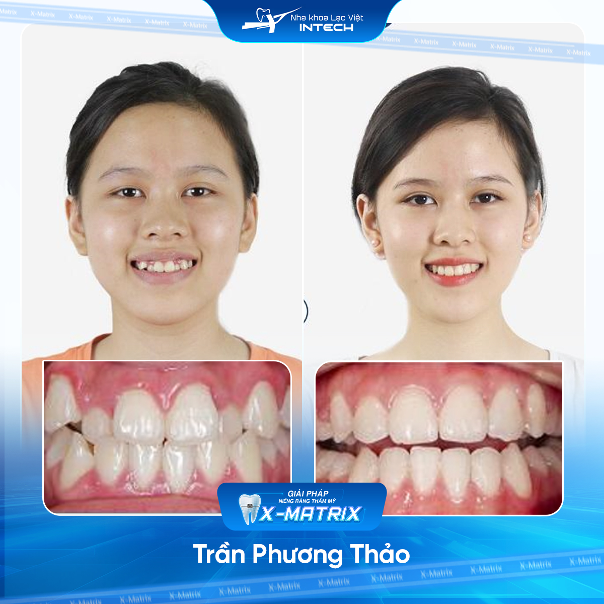 Bac si nieng rang Thu Anh nha khoa Lac Viet Intech
