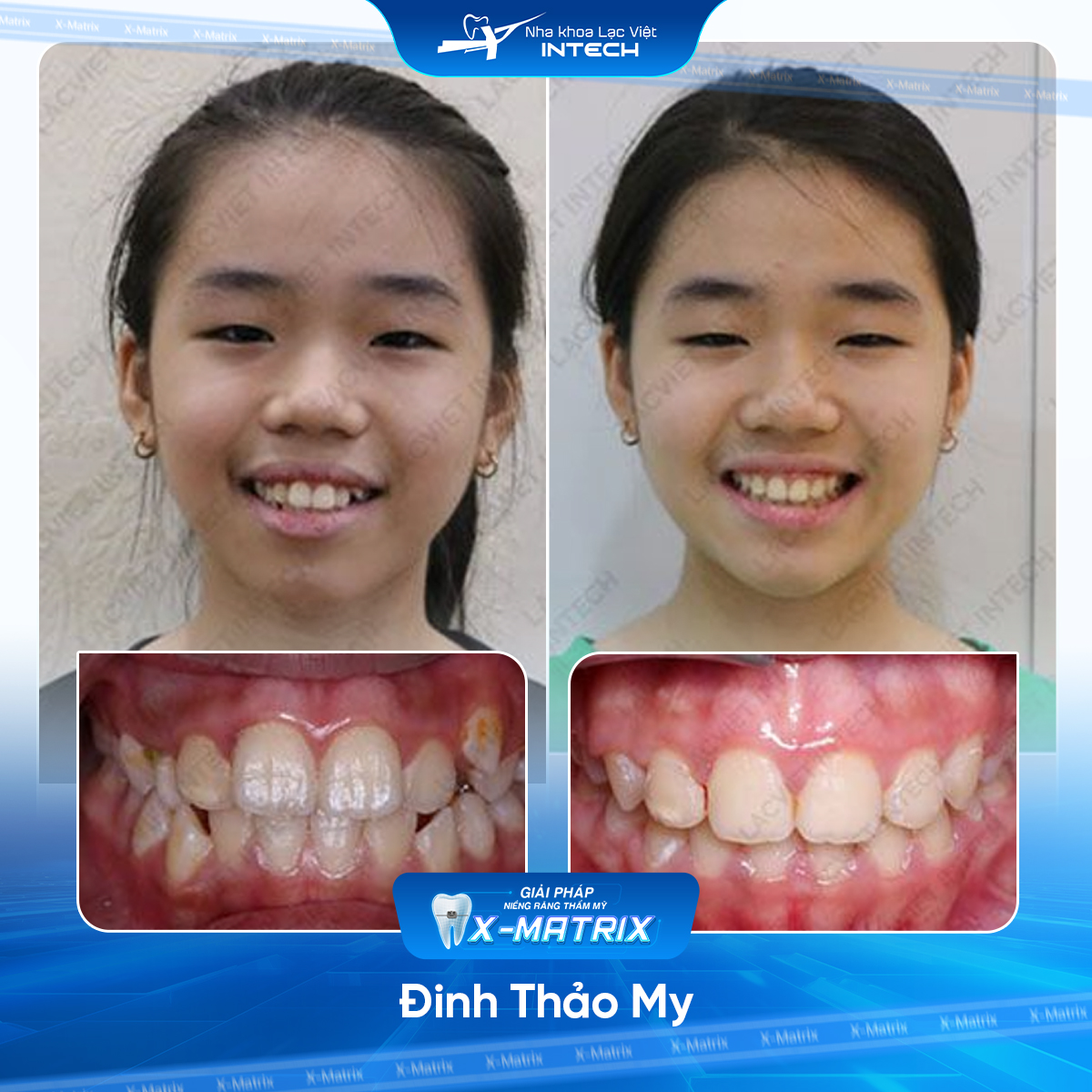 Bac si nieng rang Thu Anh nha khoa Lac Viet Intech