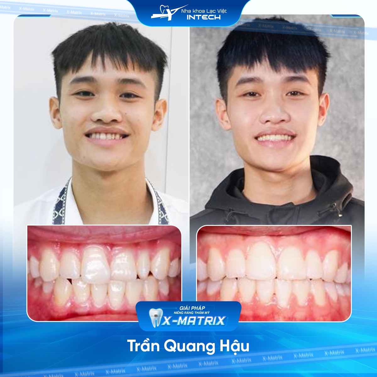 Bac si nieng rang Thu Anh nha khoa Lac Viet Intech