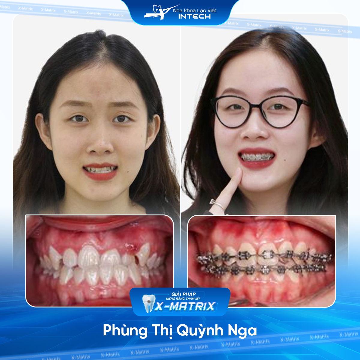Bac si nieng rang Thu Anh nha khoa Lac Viet Intech