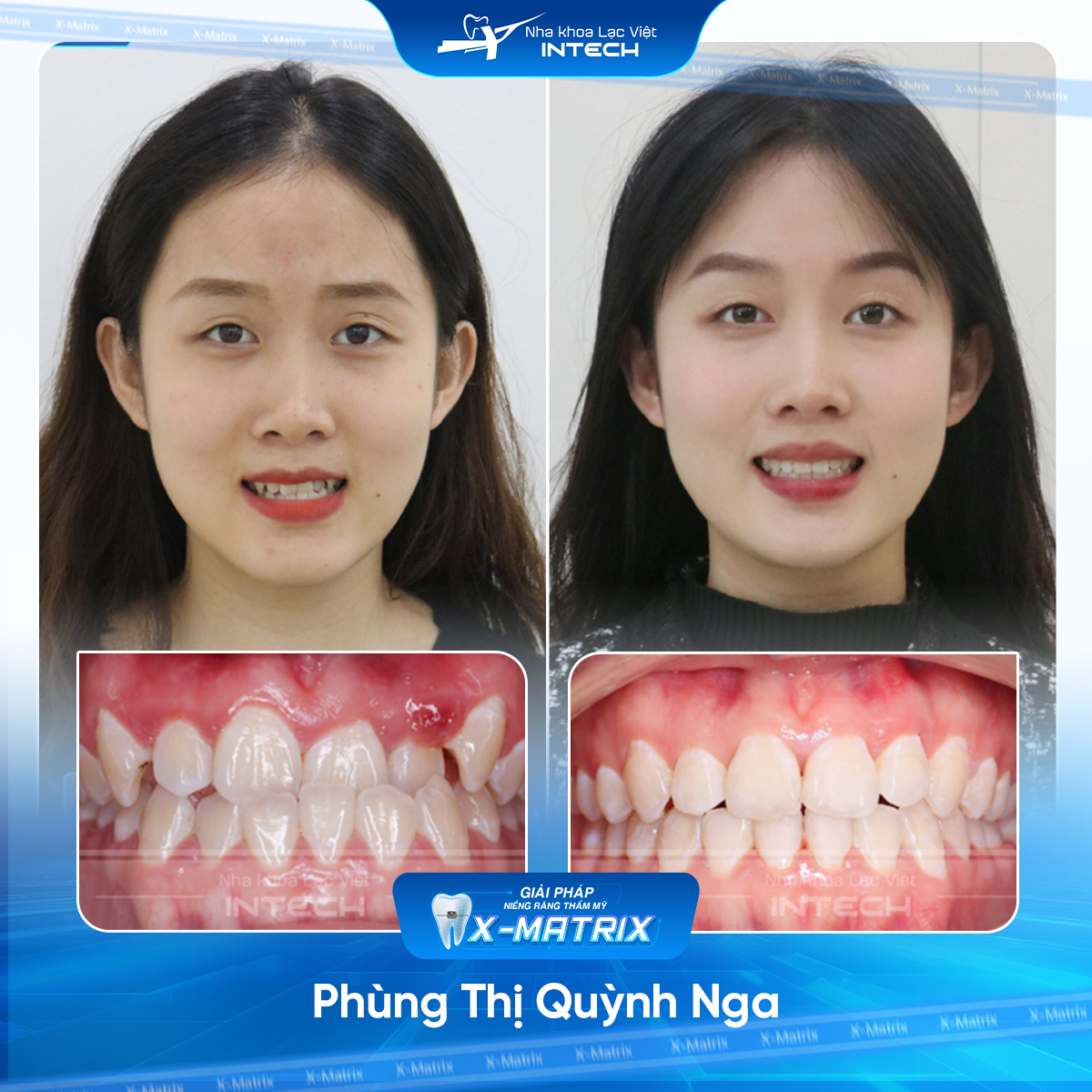 Bac si nieng rang Thu Anh nha khoa Lac Viet Intech