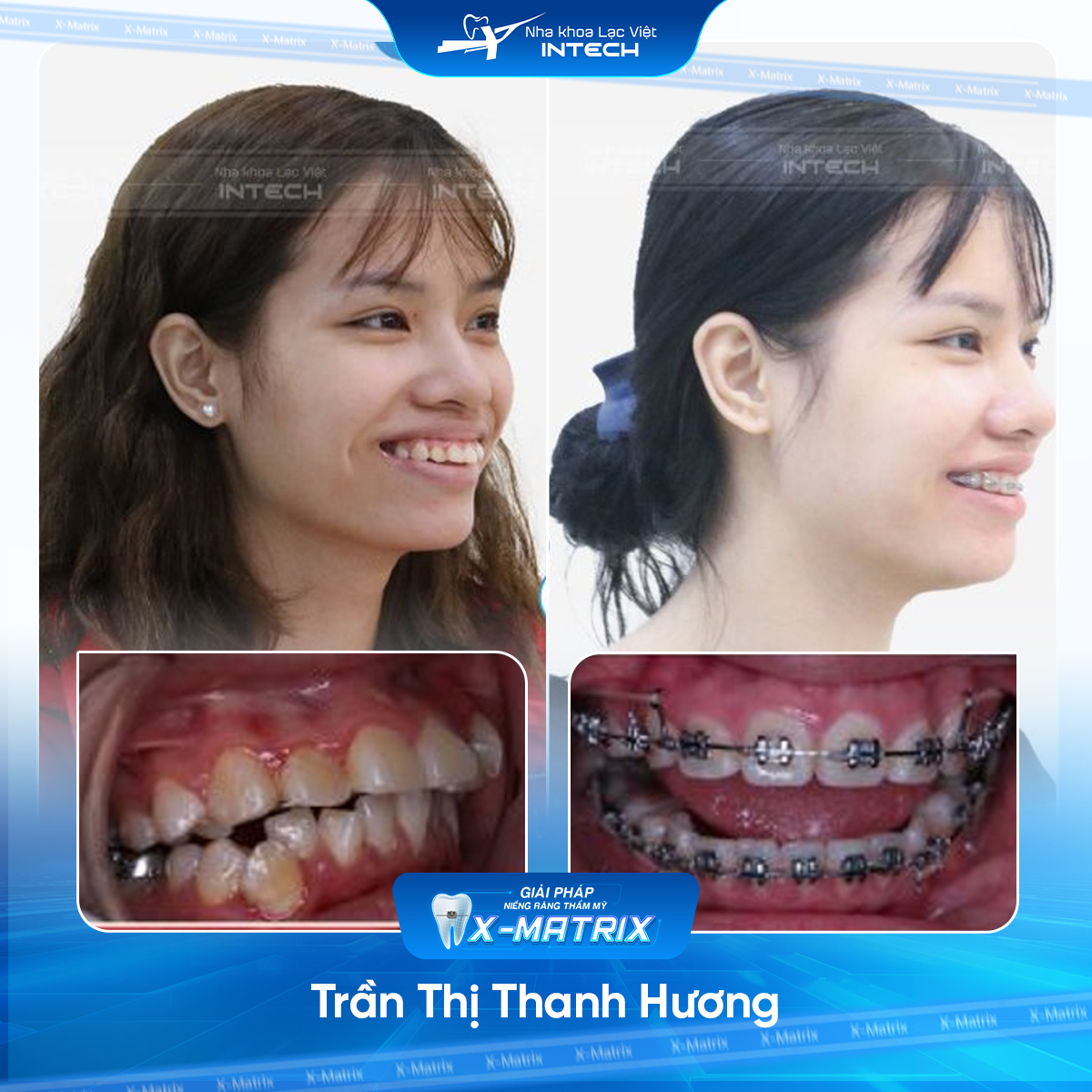 Bac si nieng rang Thu Anh nha khoa Lac Viet Intech