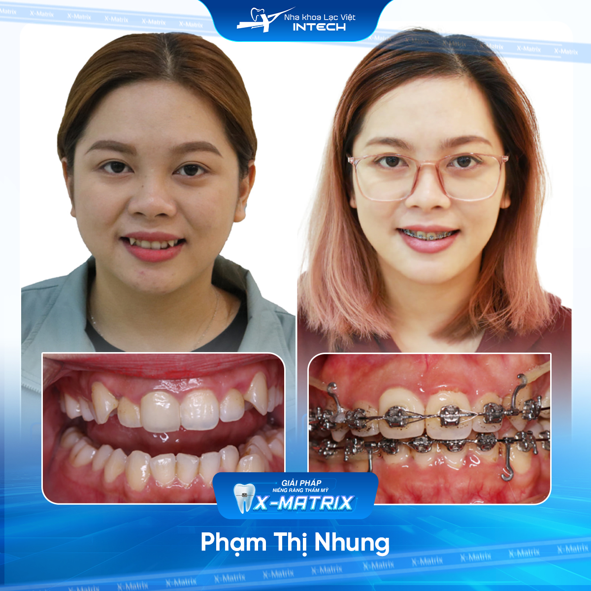 Bac si nieng rang Ngoc Anh nha khoa Lac Viet Intech