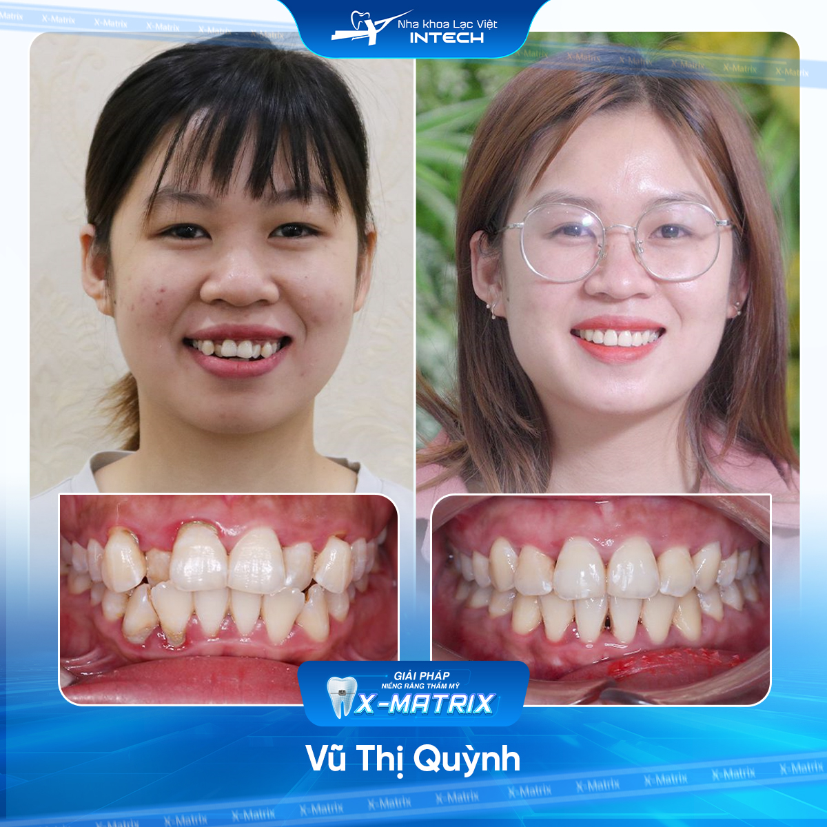 Bac si nieng rang Ngoc Anh nha khoa Lac Viet Intech