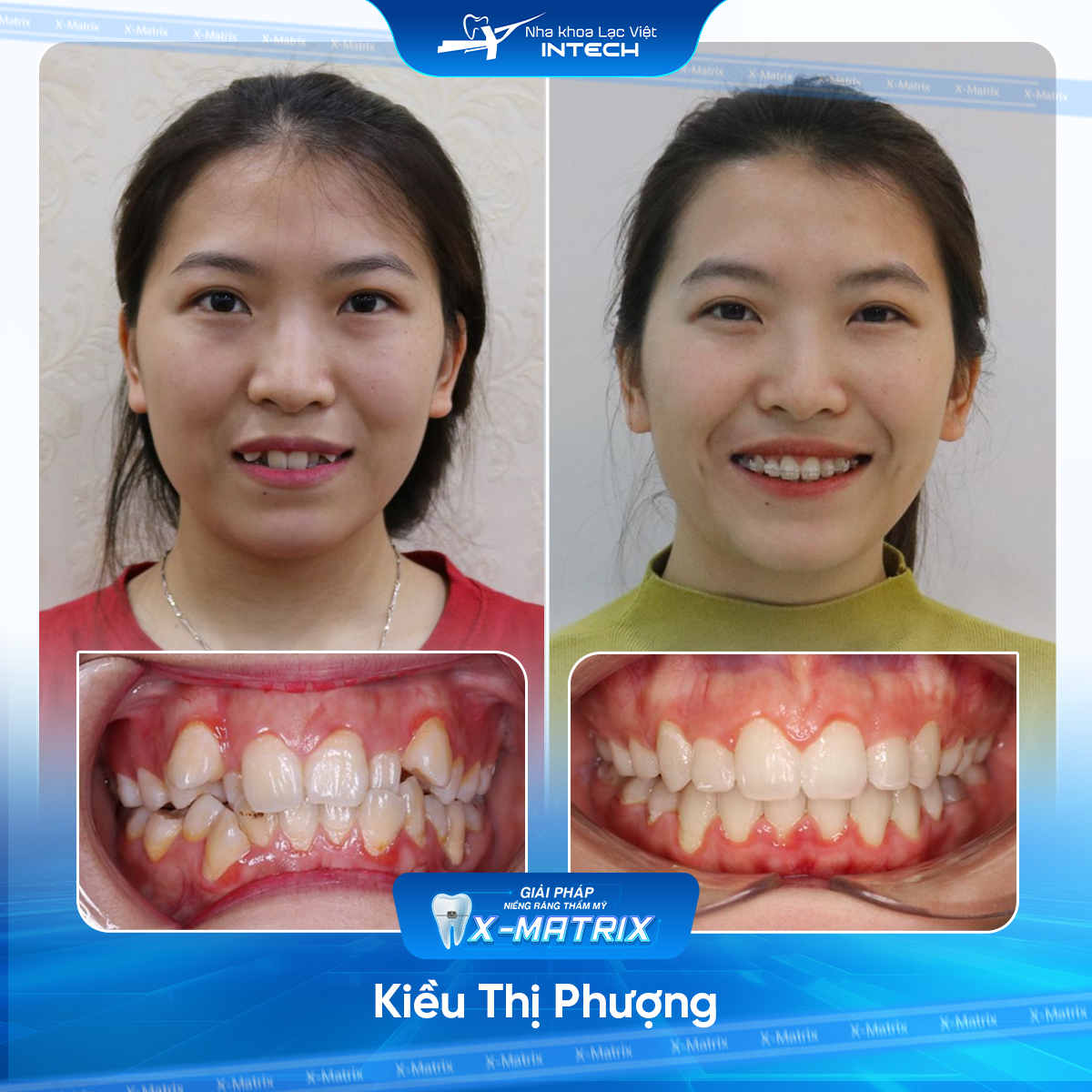 Bac si nieng rang Ngoc Anh nha khoa Lac Viet Intech