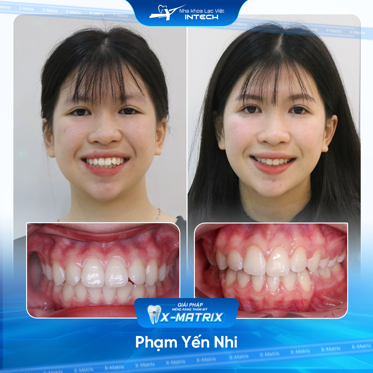 Bac si nieng rang Ngoc Anh nha khoa Lac Viet Intech