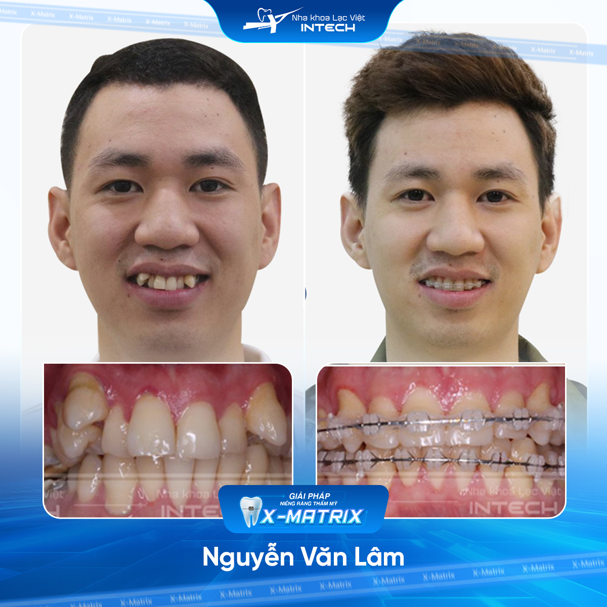 Bac si nieng rang Ngoc Anh nha khoa Lac Viet Intech