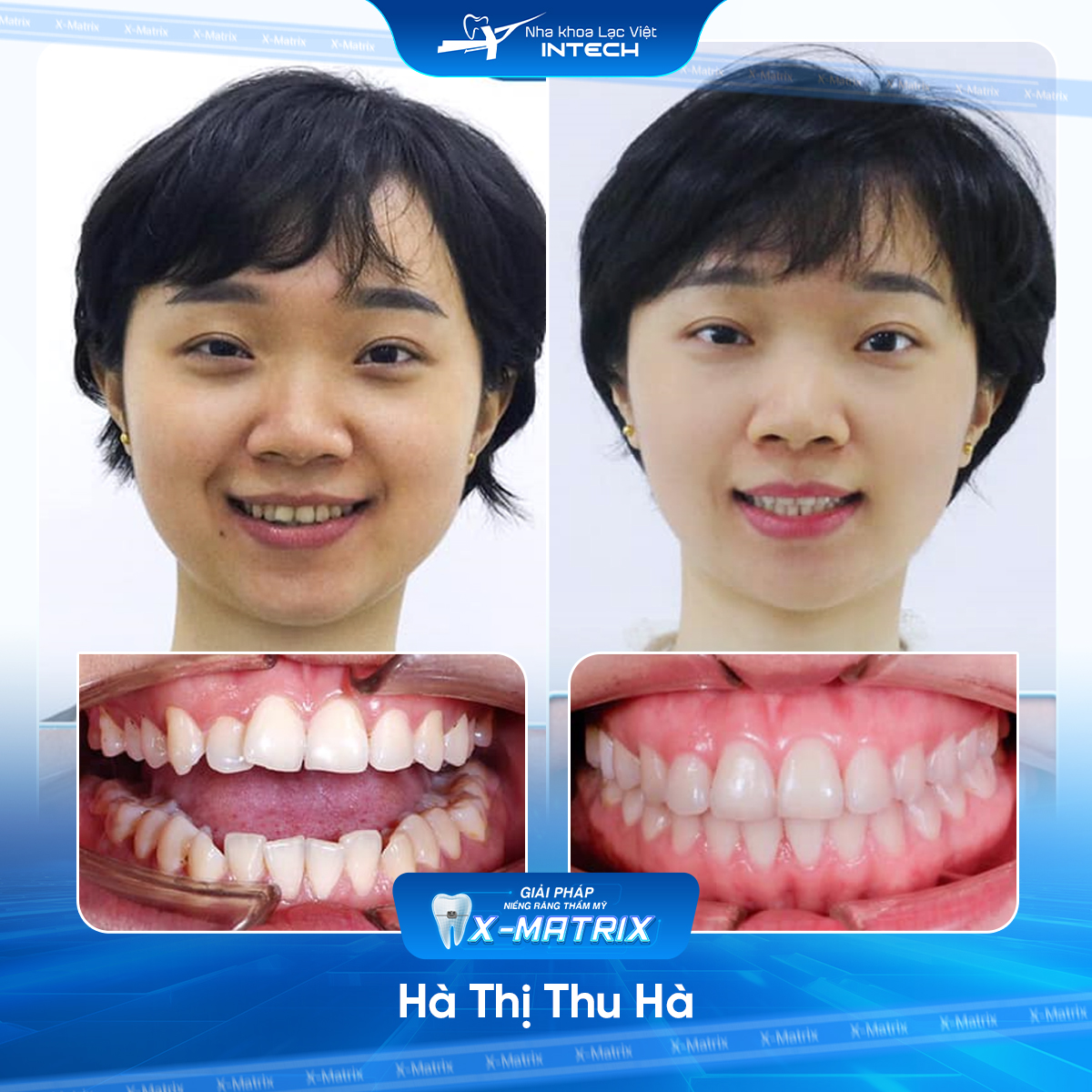 Bac si nieng rang Ngoc Anh nha khoa Lac Viet Intech