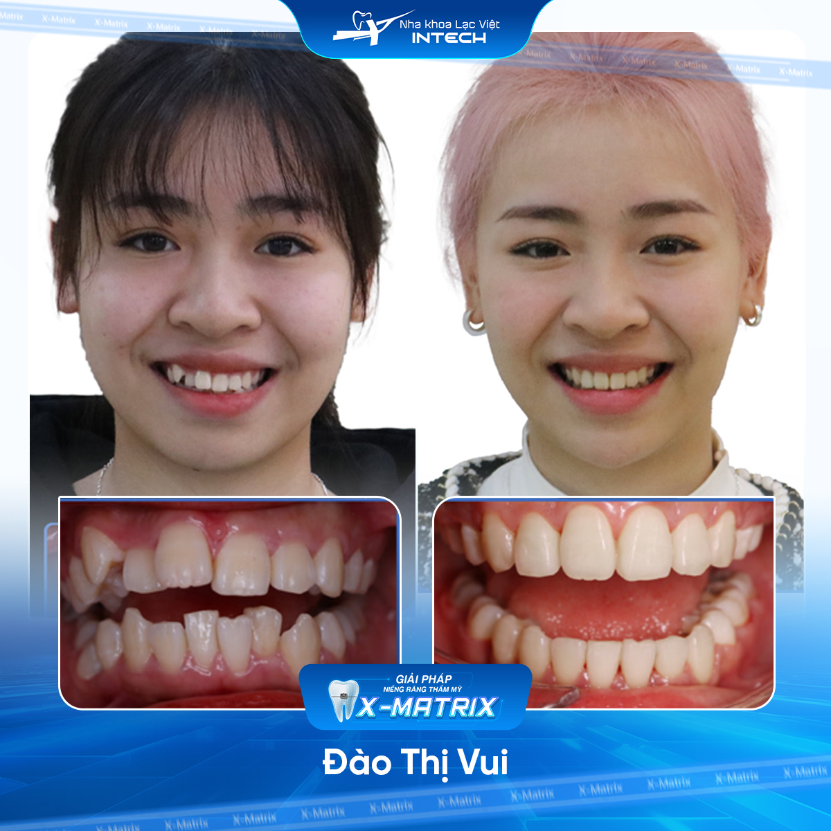 Bac si nieng rang Ngoc Anh nha khoa Lac Viet Intech