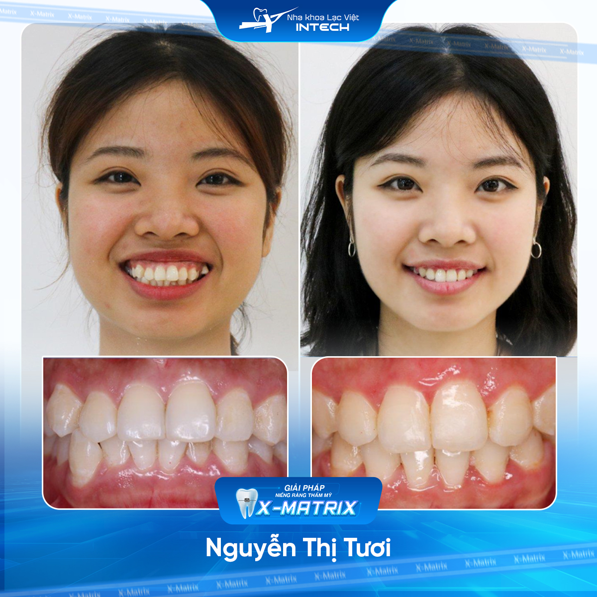 Bac si nieng rang Ngoc Anh nha khoa Lac Viet Intech