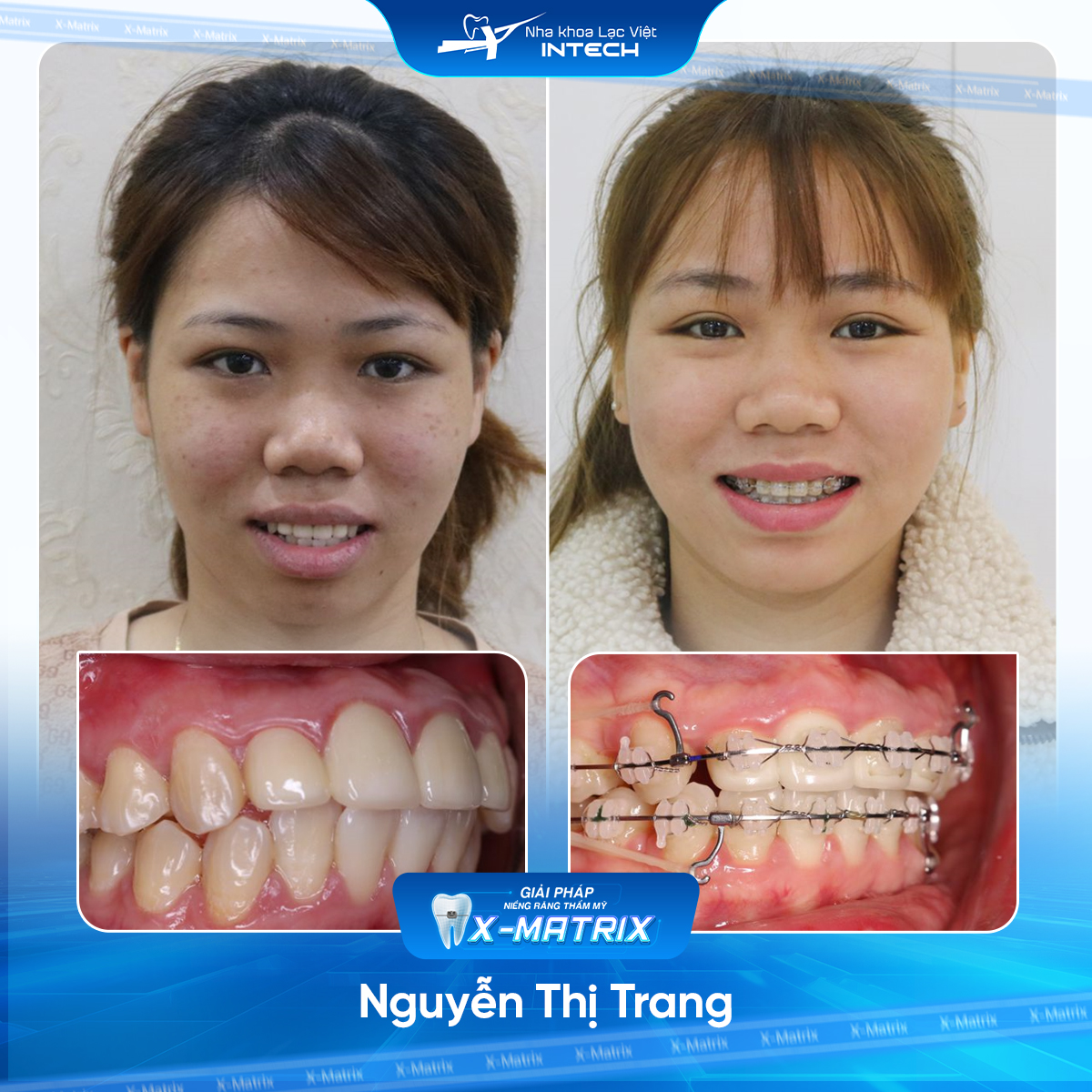 Bac si nieng rang Ngoc Anh nha khoa Lac Viet Intech