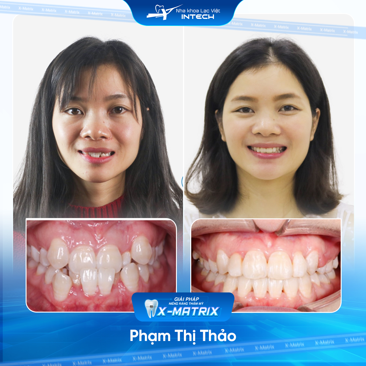 Bac si nieng rang Ngoc Anh nha khoa Lac Viet Intech